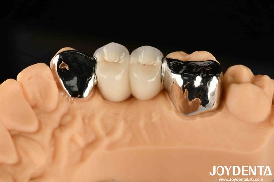 Metal Dental Maryland Bonded Bridge Remediasi Baik Untuk Perbaikan Klinis Oral
