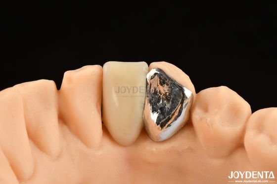 Ideal Mencocokkan Klinis Bonding Maryland Dental Untuk Kerja Perbaikan Klinis Oral
