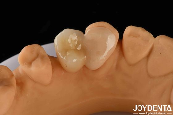 Emax Maryland Veneer Clinical Bonding Adhesion Untuk Perbaikan Gigi Yang Cocok