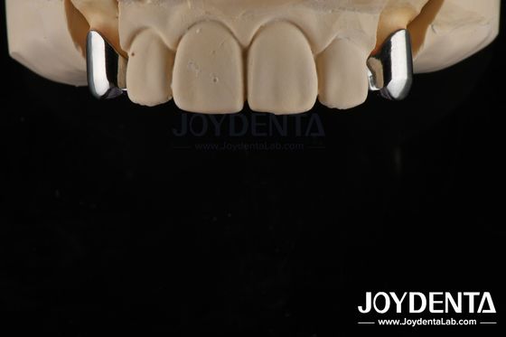 Prosthetic Removable Precision Dental Implant Attachments Mudah Bersih Nyaman Cocok