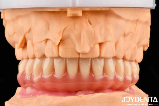 Prothesis Acrylic yang terlihat alami memiliki kemampuan biokompatibilitas yang tinggi dengan teknologi pengaturan gigi