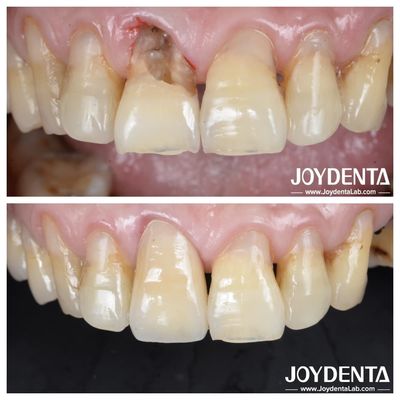 Gelas permukaan gigi gigi Zirconia mahkota untuk posterior dan anterior restorasi