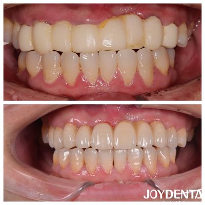 Jembatan Zirconia Gigi Berlapis Berwarna Alam Untuk Pengalaman Pasien yang Optimal