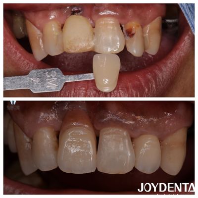 Disesuaikan Dental Zirconia veneers Warna alami restorasi seperti kehidupan penampilan gigi