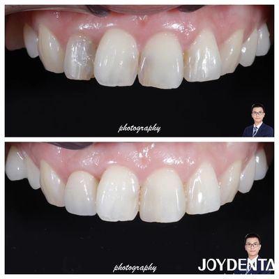 Estetika Translucence Zirconia mahkota terlihat alami ketahanan fraktur tinggi
