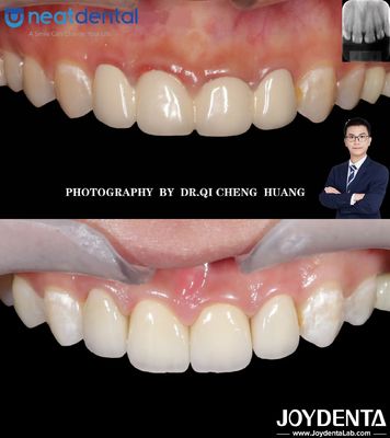 Tinggi Translucence Multilayer Zirconia Mahkota Untuk Bagian Depan Bagian Belakang Gigi Resistant retak