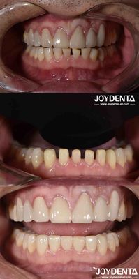 Bentuk Alam Kosmetik Kedokteran Gigi Porselin Veneers, Dental Kosmetik Porselin Veneers