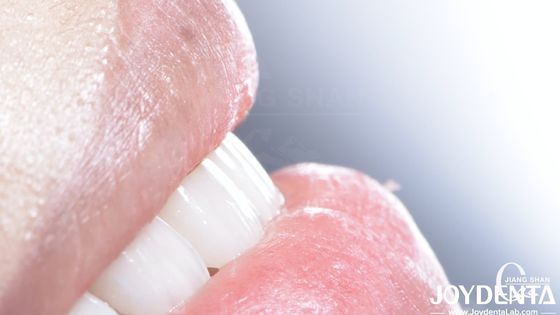 Panci Komposit Gigi yang Bertahan Lama Biokompatibilitas yang Baik Tidak Ada Drop Off veneer porselen