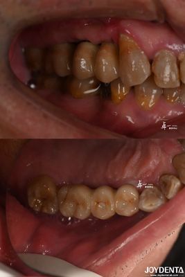 Desain permukaan kasar implan gigi untuk bahan titanium tingkat tulang subcrestal