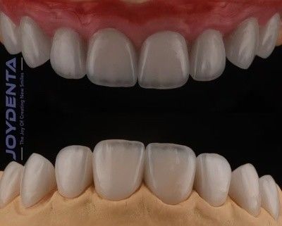 Feneri Feldspathic Translucence Tinggi, Feneri Porselen Kosmetik Dengan Adhesi yang Kuat