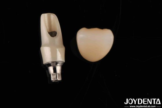 Zirconia Custom Abutments And Bars Restorasi gigi untuk anatomi pasien individu