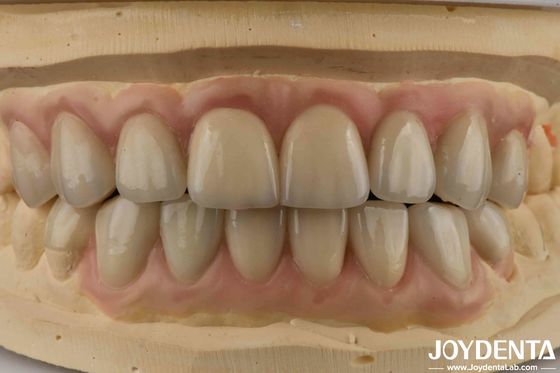 Translucence Tinggi Emax Kosmetik Kedokteran Gigi Veneers Estetika Tinggi Ultra Tipis