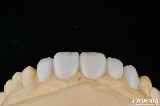 Personaliasi Bahan Porselen Emax veneer gigi untuk ikatan estetika tinggi