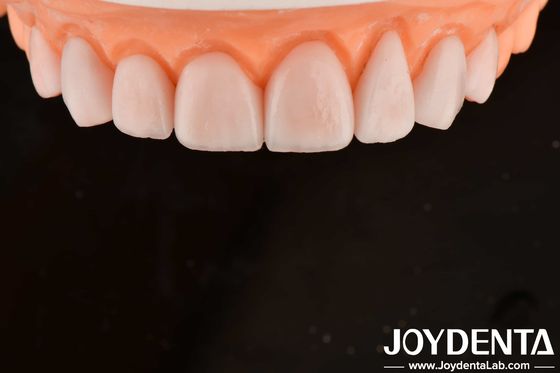 Custom Made IPS Porselen Emax Veneers Restorasi gigi Tahan retak