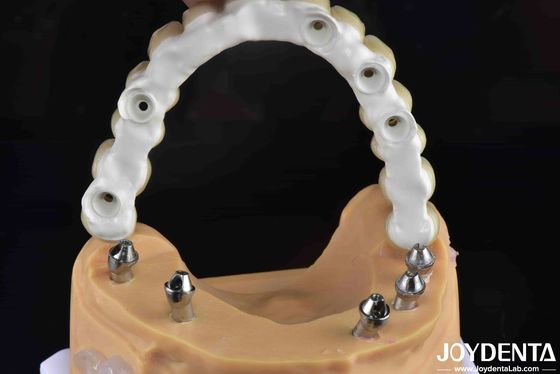High-Strength Ti-Base Hybrid Zirconia Bridge Resistance Fracture Dental Solution