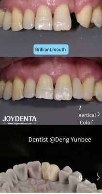 Resin Bonded Maryland Bridge Gigi Belakang untuk Flossing Sikat Biasa