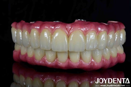 Jembatan Hibrida Titanium Dental Ringan Nyaman Untuk Restorasi Gigi