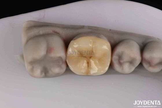 Disesuaikan Zirconia Inlay Onlay Persiapan Minimal Untuk Restorasi Gigi yang Rusak