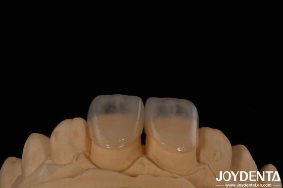 Eco Friendly Micro Dental Teeth Veneer 0.2mm Ketebalan Tekstur halus