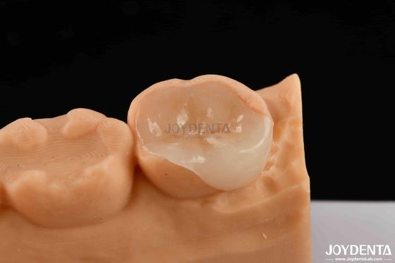 Polymerized porselen Komposit Inlay Dan Onlay Estetika Dan Durable Restorasi