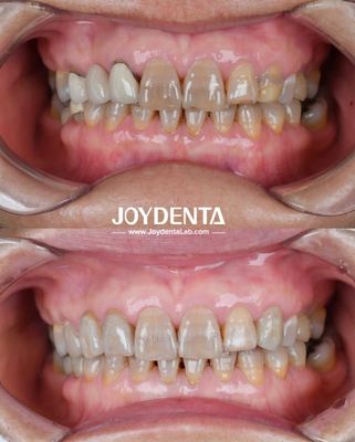 Zirconia Gigi Ringan Untuk Pengalaman Pasien Optimal Transisi Warna Alami Dan Biokompatibilitas Dijamin