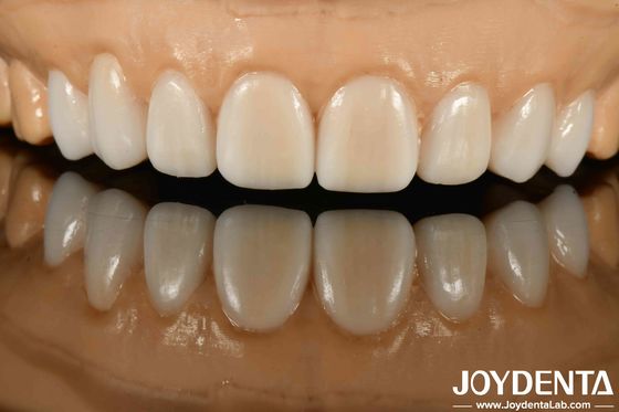 High Stealth Berbagai Bahan Logam Dan Resin Fleksibel Denture Finish Untuk Teknologi Stealth Canggih