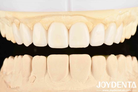 Elastisitas Gigi yang Baik Dan Teknologi Pengaturan Gigi Fleksibel Denture Finish Dalam Perawatan Gigi