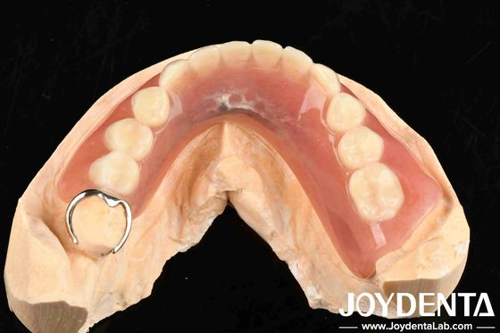 Logam dan resin rangka membuat gigi akhir untuk struktur mulut yang stabil dalam konfigurasi gigi