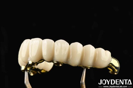Nyaman Dipakai Ti-Bar Zirconia Hybrid Bridge Memulihkan Fungsi Mengunyah Kompatibel dengan Gigi dan Gusi Alami