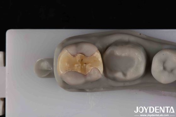 Low Translucency Inlay Onlay Cementasi aman untuk restorasi yang tahan lama dan estetis