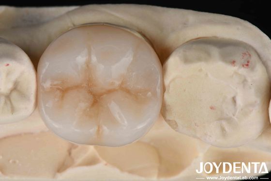 Multilayer Full Zirconia Kombinasi Ultimate Kekuatan Dan Estetika Untuk Restorasi Gigi