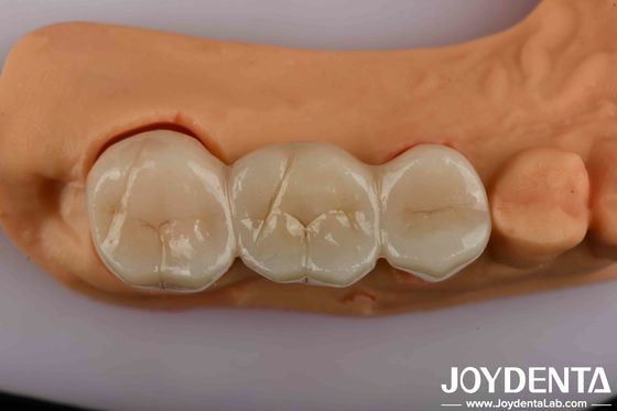 Zirconia Gigi Kekuatan Tinggi Solusi Utama Anda Untuk Estetika Tampilan Alami