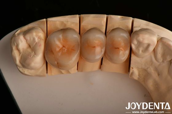 Tahan retak tinggi dan estetika yang terlihat alami dengan teknologi multilayer full zirconia