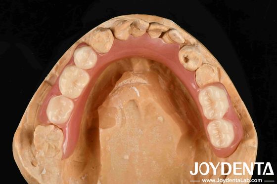 Personalifikasi Dental Akrilik Finish Elastisitas Baik Dan Properti Ringan Untuk Performa Prostetik yang Ditingkatkan
