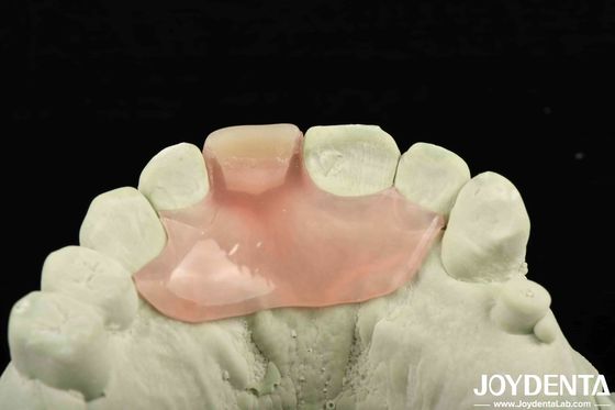 Personalize Flexible Denture Finish dengan menggunakan teknologi pengaturan gigi dengan elastisitas yang baik