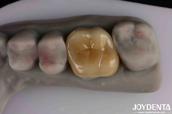 Translucence Medium Emax Inlay Onlay Mudah dibersihkan Dan Biokompatibilitas Non-toksik Dalam Bahan