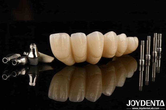 Pengalaman Estetika Ultimate Dengan Dental Implantasi Mahkota dan Jembatan