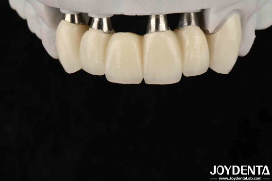 Crown dan Jembatan Implantasi yang Dapat Disesuaikan untuk Biokompatibilitas Oral yang Aman