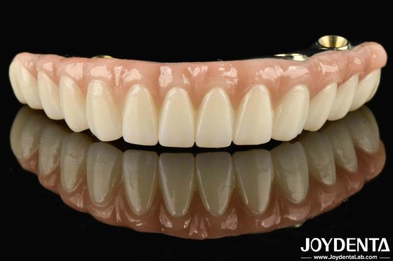 Ti-Bar Zirconia Hybrid Bridge Kompatibel dengan Gigi dan Gusi Autabiografi Memulihkan Fungsi Mengunyah