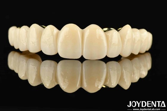 Jembatan Hibrida Zirconia Ti-Bar yang dibuat khusus Kombinasi yang sempurna untuk kenyamanan dan fungsionalitas