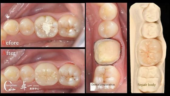 Biokompatibilitas Dan Kompatibilitas Tinggi Dengan Gigi Alami Restorasi Inlay Gigi Restoratif