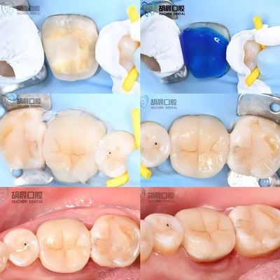 Rasakan Keakuratan Inlay Gigi Murah Dan Putih Untuk Cocok Sempurna
