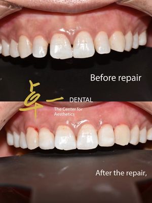 Katakan Halo untuk senyum yang sempurna dengan veneer gigi kosmetik Tidak ada perubahan warna Tidak ada persiapan