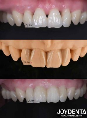 Grasshopper Veneers Solusi yang Sempurna untuk Garis Gigi Translucence Alam