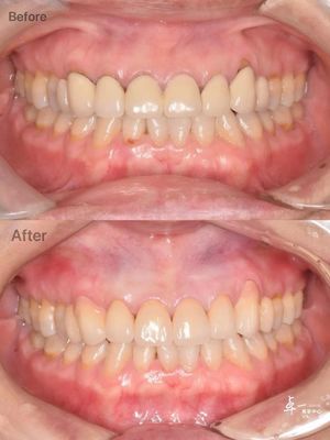 Zirconia Gigi Bertahan Fraktur Tinggi Untuk Jaringan Oral yang Aman Dan Kompatibilitas CAD / CAM