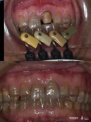 Translucency Zirconia Crown Teknologi Gradien Berlapis Berbagai Untuk Translucency Optimal Dan Biokompatibilitas Jangka Panjang