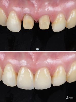Veneer yang dibuat dengan zirconia gigi tahan fraktur tinggi dan teknologi gradien multilayer