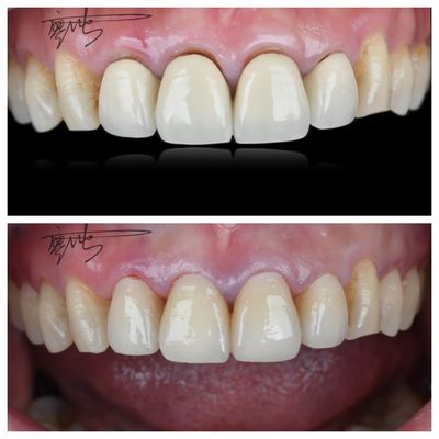 Jembatan Gigi Zirconia yang Nyaman Transisi warna alami ringan untuk pengalaman pasien yang optimal