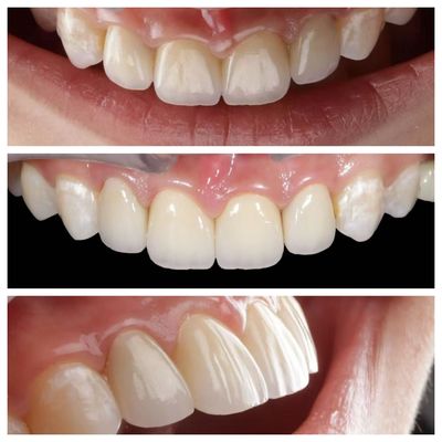 Indikasi gigi depan veneer gigi dengan ketebalan 0,5 mm dan permeabilitas sempurna