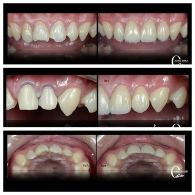 Furnir Gigi Alam Untuk Senyum Yang Alami Dan Cantik